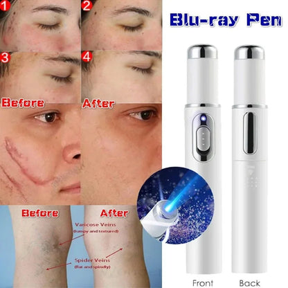 Blue Light Therapy Acne Removal Laser Pen Skin Spots Removal Machine Anti Wrinkle Anti Varicose Spider Vein Eraser Treatment